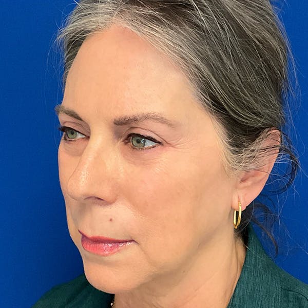 Blepharoplasty Before & After Gallery - Patient 179956 - Image 4
