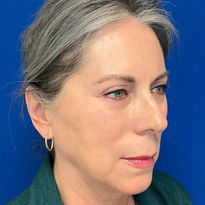 Blepharoplasty Before & After Gallery - Patient 179956 - Image 6