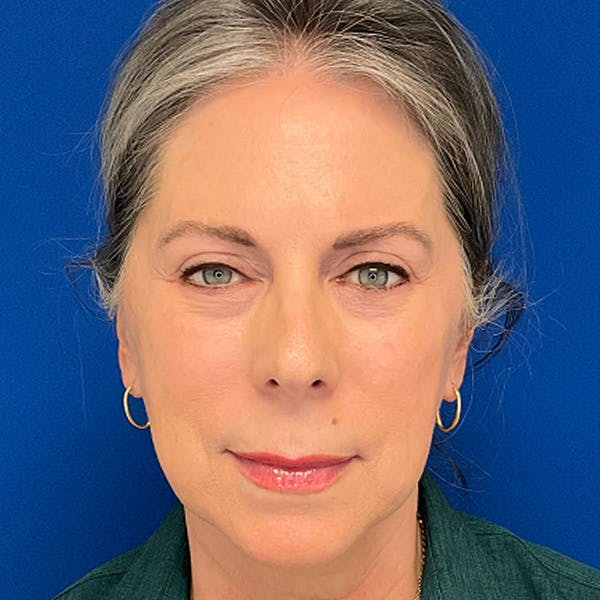 Blepharoplasty Before & After Gallery - Patient 179956 - Image 2