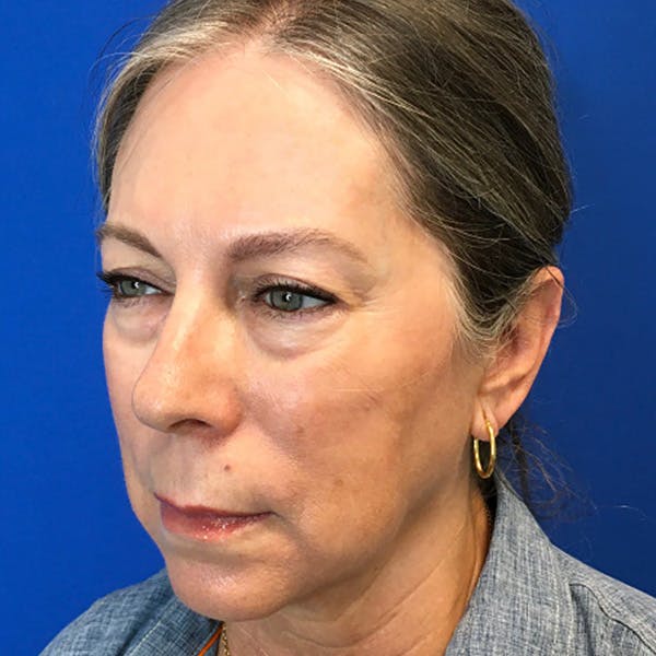 Blepharoplasty Before & After Gallery - Patient 179956 - Image 3