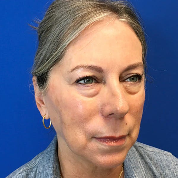 Blepharoplasty Before & After Gallery - Patient 179956 - Image 5