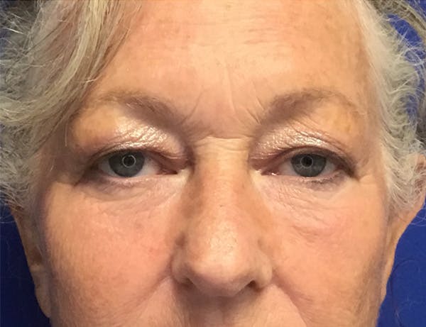 Blepharoplasty Before & After Gallery - Patient 382398 - Image 1