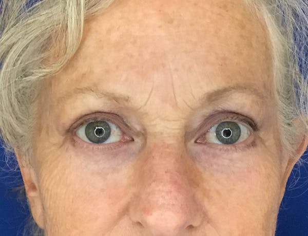 Blepharoplasty Before & After Gallery - Patient 382398 - Image 2