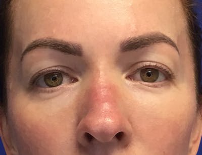 Blepharoplasty Before & After Gallery - Patient 215310 - Image 1