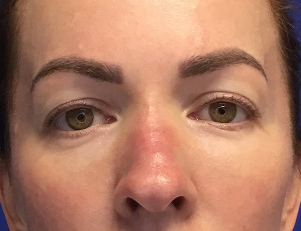 Blepharoplasty Before & After Gallery - Patient 215310 - Image 1