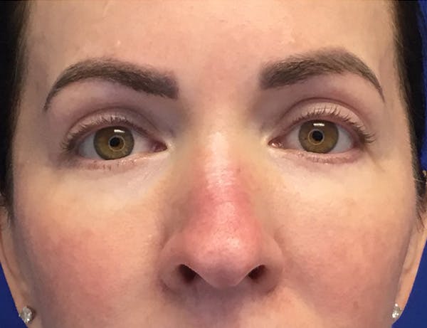 Blepharoplasty Before & After Gallery - Patient 215310 - Image 2