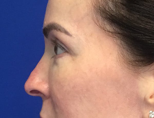 Blepharoplasty Before & After Gallery - Patient 215310 - Image 4