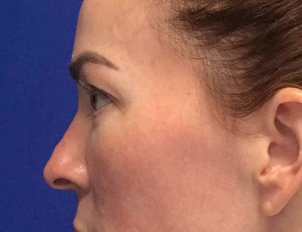 Blepharoplasty Before & After Gallery - Patient 215310 - Image 3