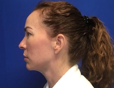 Neck Lift Before & After Gallery - Patient 233929 - Image 1