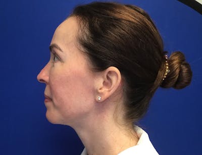 Neck Lift Before & After Gallery - Patient 233929 - Image 2