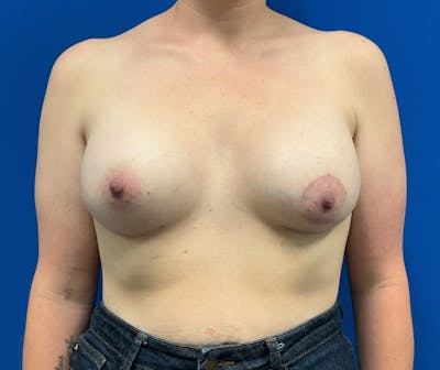 Breast Augmentation Before & After Gallery - Patient 285233 - Image 2