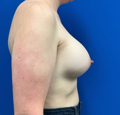 Mastopexy Before & After Gallery - Patient 236683 - Image 6
