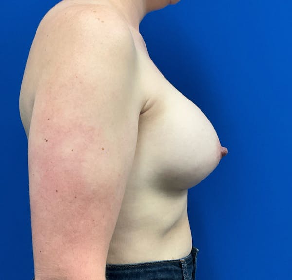 Mastopexy Before & After Gallery - Patient 236683 - Image 6