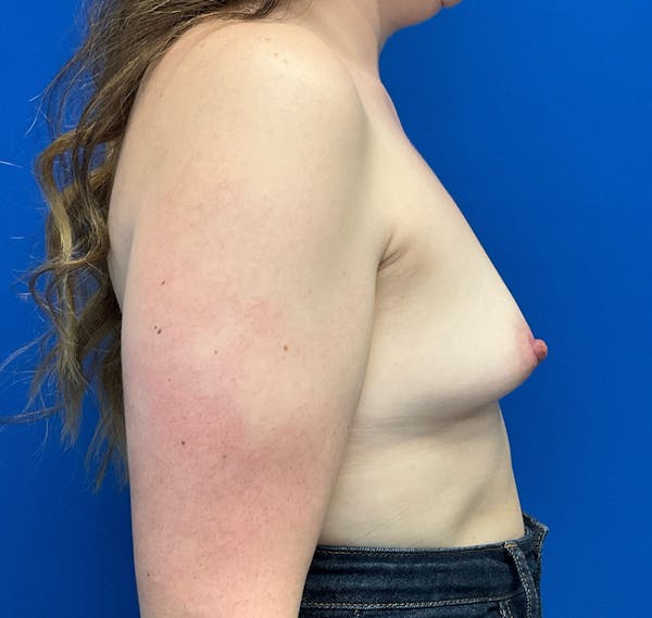 Mastopexy Before & After Gallery - Patient 236683 - Image 5