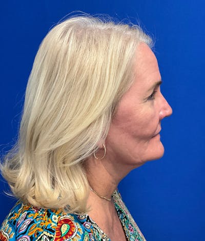 Blepharoplasty Before & After Gallery - Patient 127657 - Image 6