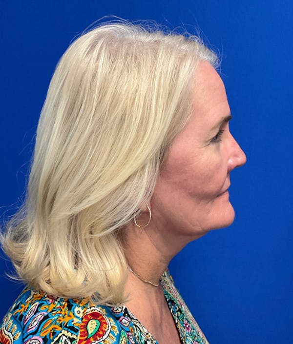Blepharoplasty Before & After Gallery - Patient 127657 - Image 6