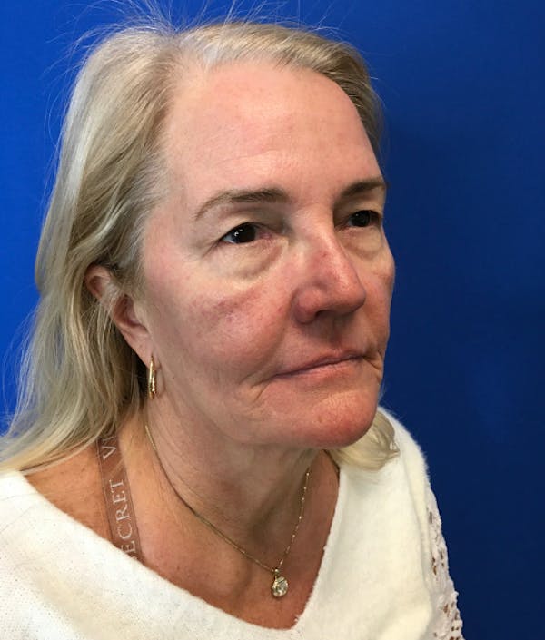 Blepharoplasty Before & After Gallery - Patient 127657 - Image 3