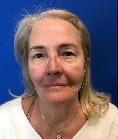 Blepharoplasty Before & After Gallery - Patient 127657 - Image 1
