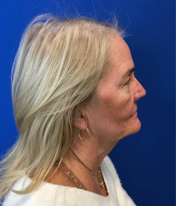 Blepharoplasty Before & After Gallery - Patient 127657 - Image 5