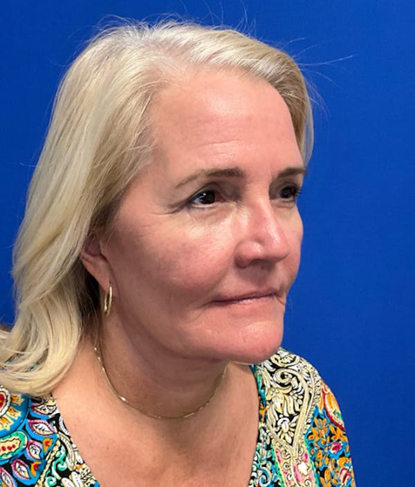 Blepharoplasty Before & After Gallery - Patient 127657 - Image 4