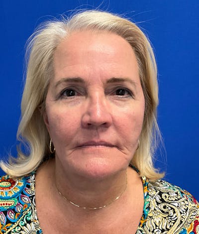 Blepharoplasty Before & After Gallery - Patient 127657 - Image 2