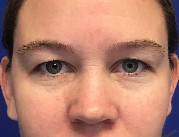 Blepharoplasty Before & After Gallery - Patient 232872 - Image 1