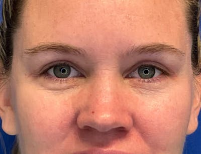 Blepharoplasty Before & After Gallery - Patient 232872 - Image 2