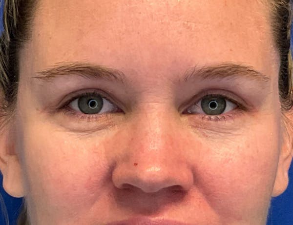 Blepharoplasty Before & After Gallery - Patient 232872 - Image 2