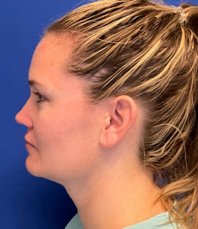 Liposuction Before & After Gallery - Patient 353164 - Image 2