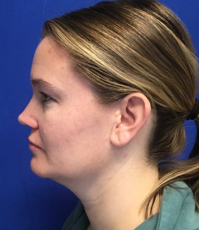 Liposuction Before & After Gallery - Patient 353164 - Image 1