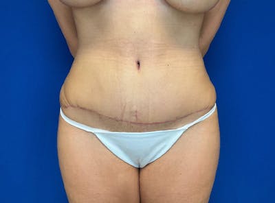 Liposuction Before & After Gallery - Patient 317152 - Image 2