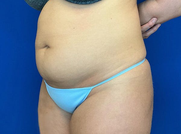 Liposuction Before & After Gallery - Patient 317152 - Image 7