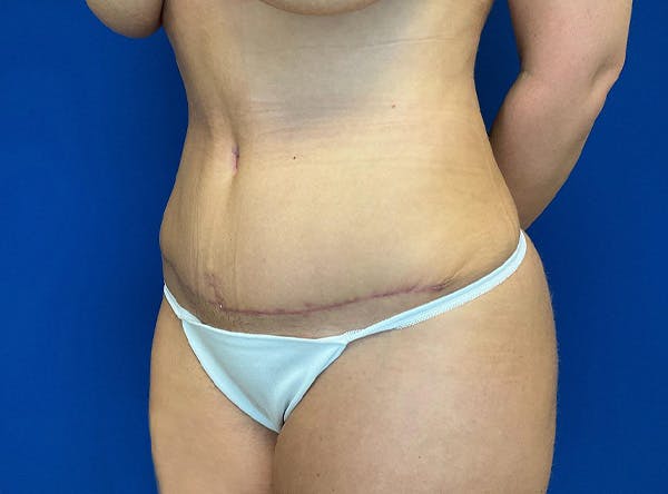 Liposuction Before & After Gallery - Patient 317152 - Image 8