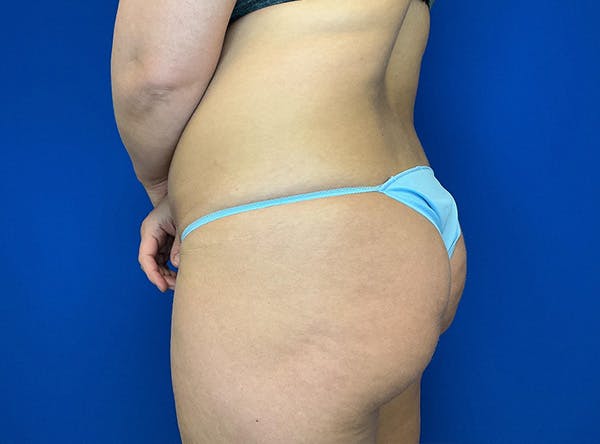 Liposuction Before & After Gallery - Patient 317152 - Image 11