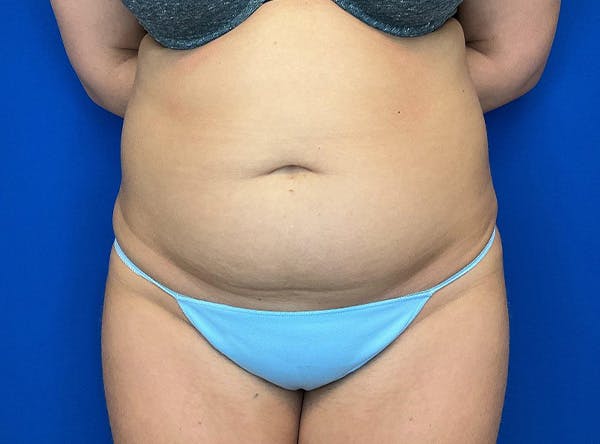 Liposuction Before & After Gallery - Patient 317152 - Image 1
