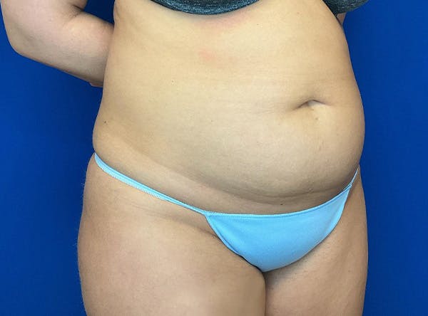 Liposuction Before & After Gallery - Patient 317152 - Image 3
