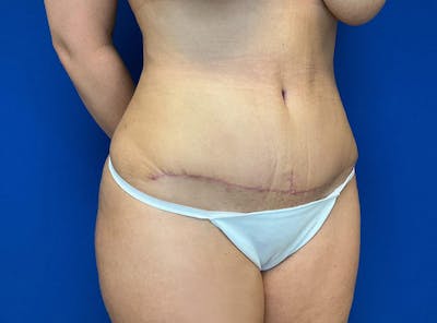 Liposuction Before & After Gallery - Patient 317152 - Image 4