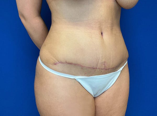 Liposuction Before & After Gallery - Patient 317152 - Image 4