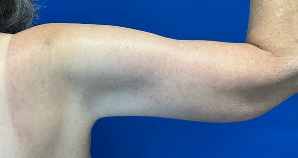Arm Lift Before & After Gallery - Patient 174255 - Image 4