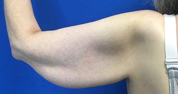 Arm Lift Before & After Gallery - Patient 174255 - Image 7