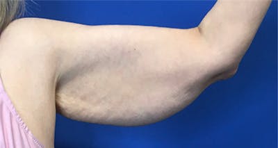 Arm Lift Before & After Gallery - Patient 174255 - Image 1