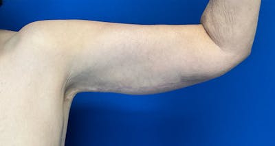 Arm Lift Before & After Gallery - Patient 174255 - Image 2