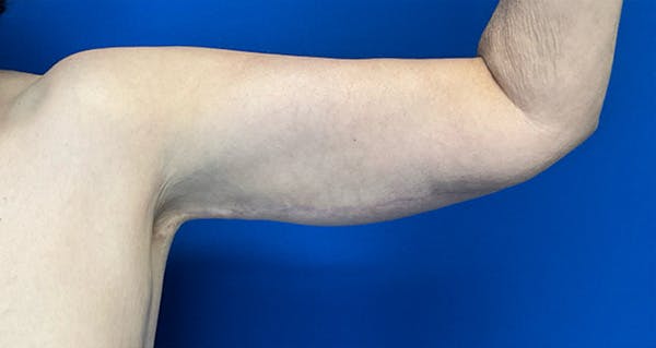 Arm Lift Before & After Gallery - Patient 174255 - Image 2