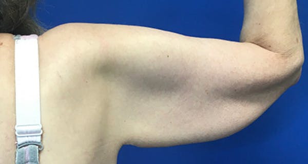 Arm Lift Before & After Gallery - Patient 174255 - Image 3