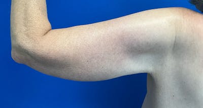 Arm Lift Before & After Gallery - Patient 174255 - Image 8