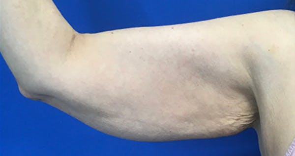 Arm Lift Before & After Gallery - Patient 174255 - Image 5