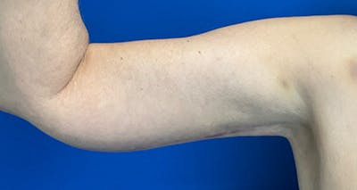 Arm Lift Before & After Gallery - Patient 174255 - Image 6