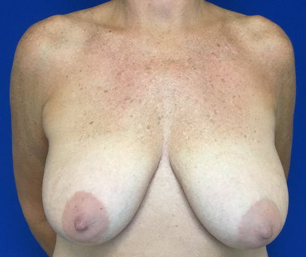 Mastopexy Before & After Gallery - Patient 251676 - Image 1