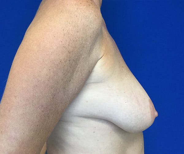 Mastopexy Before & After Gallery - Patient 251676 - Image 3