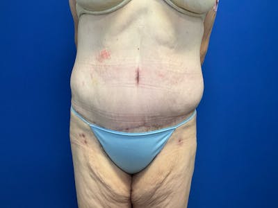Tummy Tuck (Abdominoplasty) Before & After Gallery - Patient 299767 - Image 2